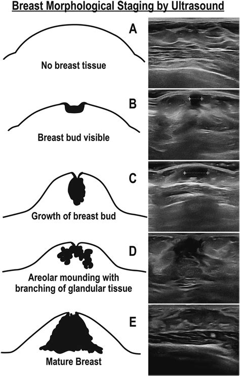 What do breast buds look like?